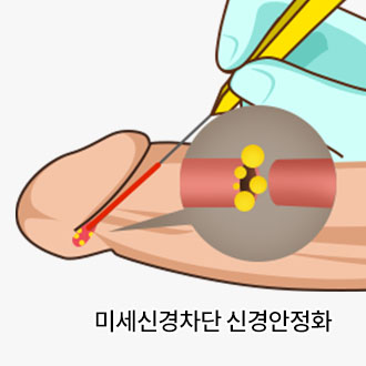 체외충격파 시술과정01