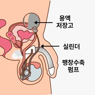 체외충격파 시술과정01