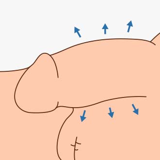 체외충격파 시술과정04