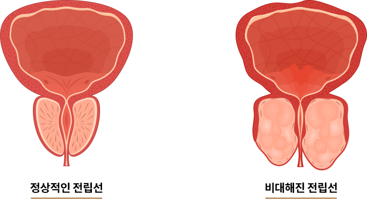 전립선 비대증이란?