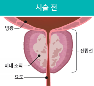 리줌 시술과정01