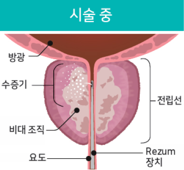 리줌 시술과정02