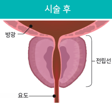 리줌 시술과정03